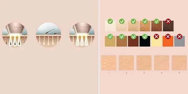 Obrázek PHILIPS Lumea Advanced IPL SC1994/00 použití na tělo (3)